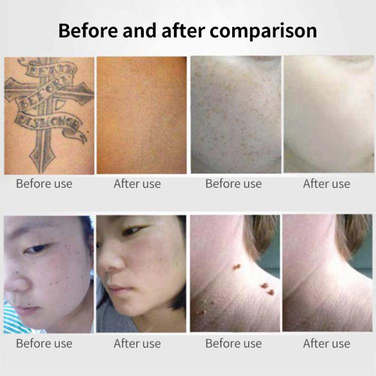 AA-A401 Portable Laser Beauty Instrument Mole Removal Freckle Removal Beauty Laser Pen, Specification:Blue Light Plug-in