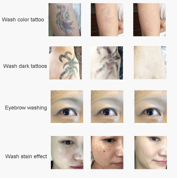 Laser Tattoo Removal Machine Non-invasive Eyebrow Washing Beauty Equipment(EU Plug)