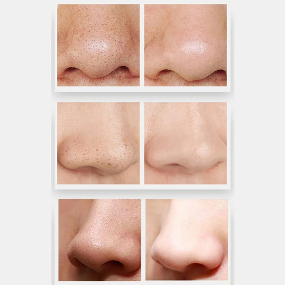 ZLY-018 Household Electric Blackhead Suction Device Pore Cleaning and Beauty Equipment(Standard)