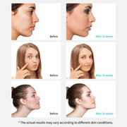 Xpreen Rechargeable Pore Cleanser Home Facial Beauty Device with LED Screen & 4 Probes