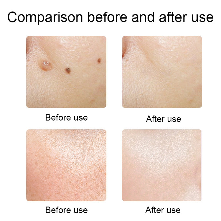 FY-106 Portable Mole and Freckle Removal Pen Household Laser Beauty Equipment(Blue)